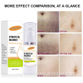 stretch marks removal cream